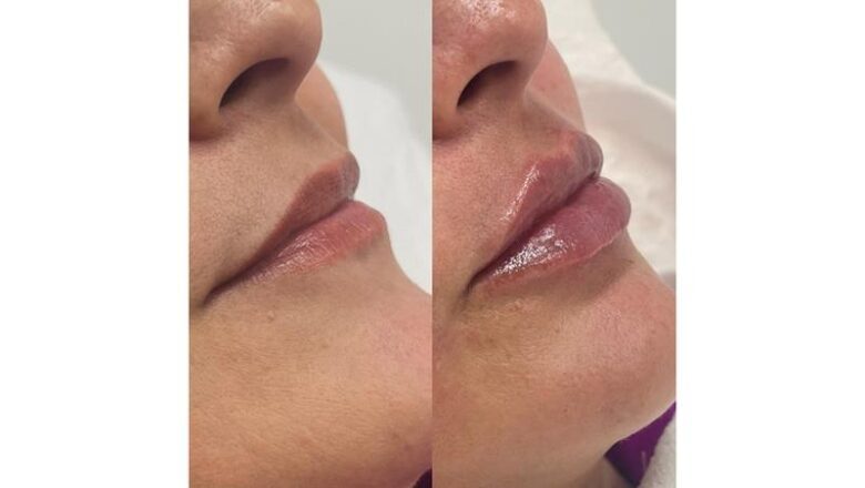 Benefícios do Preenchimento Labial na Goioerê Clínica e Harmonização facial com Dra. Daniella Oliveira