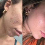 Rejuvenescimento Facial com Fotona: A Solução Avançada da Dra. Dayoha para Acne e Cicatrizes