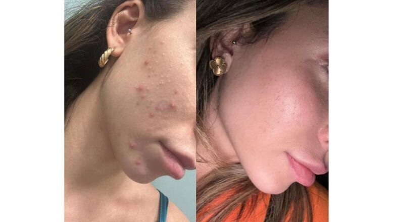 Rejuvenescimento Facial com Fotona: A Solução Avançada da Dra. Dayoha para Acne e Cicatrizes