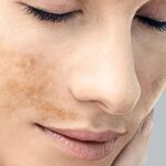 Melasma: por que o tratamento personalizado com ativos manipulados ganha força no outono