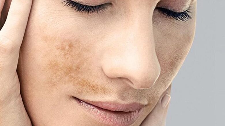 Melasma: por que o tratamento personalizado com ativos manipulados ganha força no outono