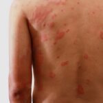 Hanseníase: diagnóstico precoce é fundamental para prevenir incapacidades e interromper a transmissão