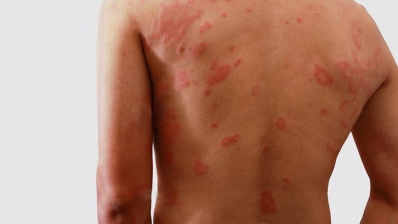 Hanseníase: diagnóstico precoce é fundamental para prevenir incapacidades e interromper a transmissão