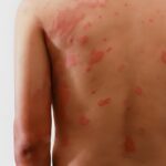 Hanseníase: diagnóstico precoce é fundamental para prevenir incapacidades e interromper a transmissão