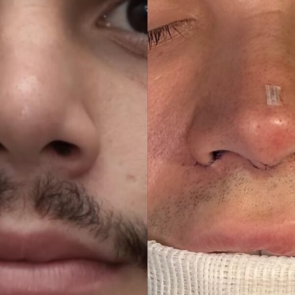 Busca por naturalidade na rinoplastia reflete a tendência do nariz natural entre influenciadores em 2026