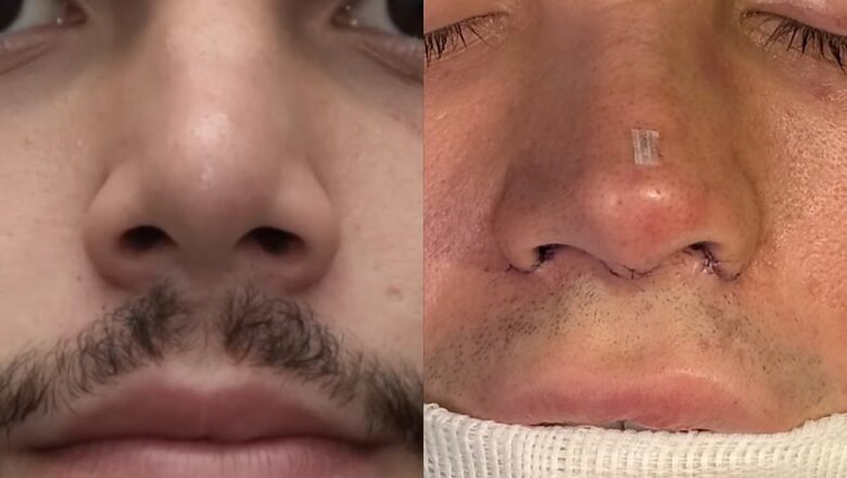 Busca por naturalidade na rinoplastia reflete a tendência do nariz natural entre influenciadores em 2026